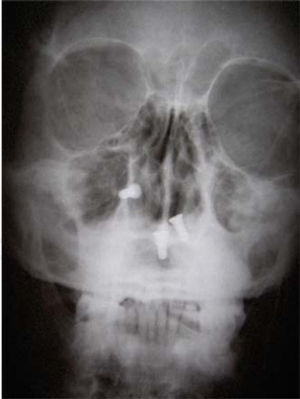 Tomografía del paciente con los implantes oseointegrados.
