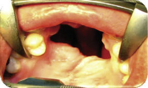Fotografía inicial intraoral. Fístula palatina anterior de 2.5 × 2.5cm.