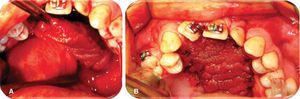 A. Rotación y eversión colgajo de lengua en lecho quirúrgico. B. Presentación de colgajo de lengua en lecho quirúrgico.