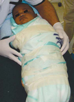Swaddling technique to control movements during surgical procedure.