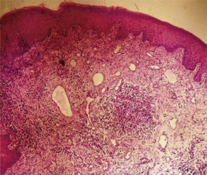 Histological section showing proliferation of small-caliber vessels surrounded by abundant polymorphonuclear neutrophiltype inflammatory cells.