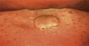 Direct inspection of the mouth under colposcopic perspective. I (Hinselmann, 2014), with 0.66 magnification. Lesion measuring 1cm diameter, of pinkish hue, circular shape, jagged edges, avascular and without pedicle.