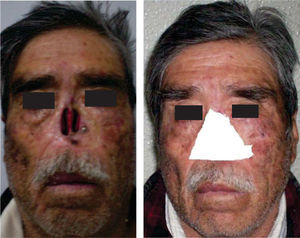 Patient with destroyed nasal cartilage after surgical intervention. Defect covered in gauze.