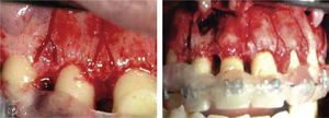 Se muestran los cortes en forma de «Y» para preservar la cresta alveolar.16