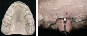 Férula maxilar modificada con resorte de níquel-titanio.7