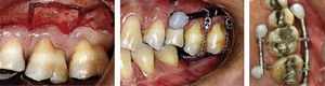 Se realiza la corticotomía en el molar a intruir para su posterior colocación de resorte de níqueltitanio.7