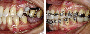 Interconsulta con el especialista en ortodoncia desde el inicio del tratamiento hasta lograr la intrusión del molar.7