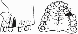 Separación de pequeños bloques óseos por unidad dental.8