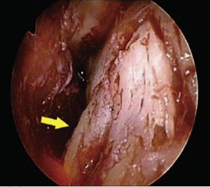 Acercamiento con el endoscopio para valorar sangrado.6