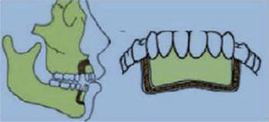 Osteotomía perisegmental por Chung.4