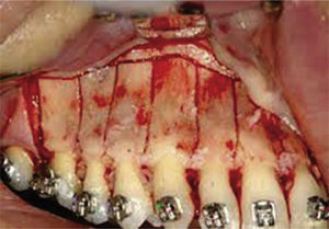 Corticotomía alveolar selectiva.10