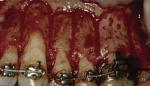 Unión de corticotomías verticales interradiculares con corticotomías semicirculares en tercio apical.3