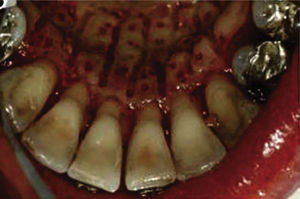 Perforaciones sobre la raíz del diente.3