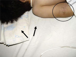 Caída de cabello y huellas de hematomas en diferentes etapas de cicatrización.