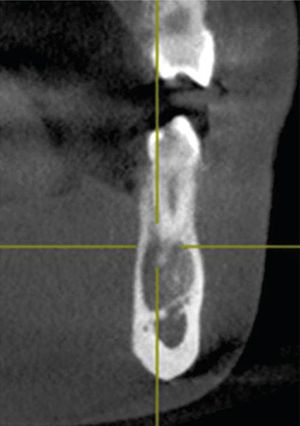 Corte transversal de la lesión en el cual se muestra el adelgazamiento de las corticales vestibular y lingual sin presentar expansión de las mismas.