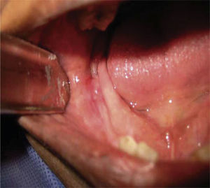 Fotografía clínica intraoral de lesión hiperémica con presencia de fístula.
