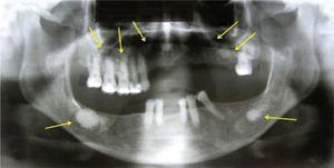 Ortopantomografía dental sinusal donde se observan múltiples imágenes radiopacas circulares, delimitadas, que involucran los cuatro cuadrantes (flechas). En el cuerpo mandibular derecho se observa una imagen radiopaca rodeada por una imagen radiolúcida que se extiende en toda la porción basal de la lesión compatible con proceso infeccioso.
