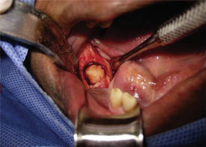 Fotografía clínica intraoperatoria de ostectomía periférica para realización de biopsia excisional de la lesión.