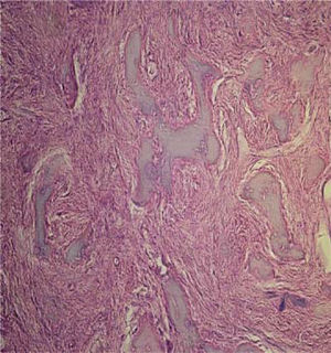 Estudio histopatológico con hematoxilina y eosina de lesión conformada por tejido óseo irregular entremezclado con fibroblastos y numerosos vasos sanguíneos delineados por endotelio de aspecto normal y repleto de eritrocitos en su interior con zonas con denso infiltrado inflamatorio linfoplasmocitario.