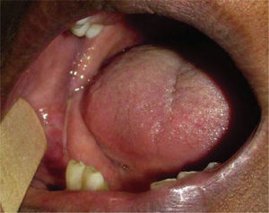 Fotografía clínica intraoral sin presencia de aumento de volumen ni cambio de coloración a nivel de la mucosa.