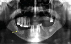 Ortopantomografía dental sinusal donde se observa zona operada con regeneración ósea adecuada (flecha) y resto de lesiones sin cambios de tamaño.