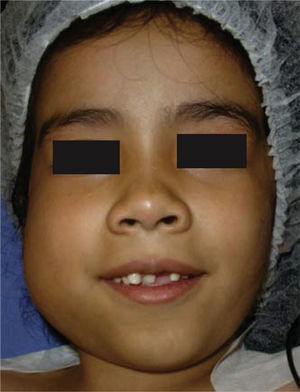 Se observa aumento de volumen en cuerpo y rama mandibular derechos.