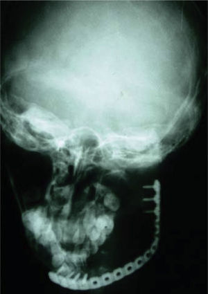 Aspecto radiográfico de prótesis de reconstrucción mandibular conservando cóndilo posterior a resección de ameloblastoma.