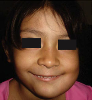 Aspecto facial dos meses posterior a resección de ameloblastoma mandibular izquierdo con colocación de prótesis de reconstrucción.