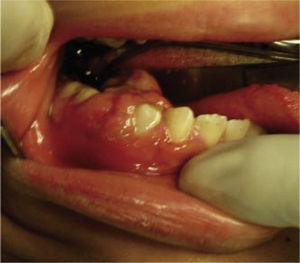 Aspecto clínico intraoral de fibroma ameloblástico mandibular derecho.