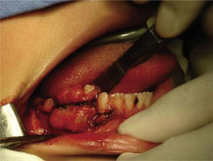Escisión quirúrgica en bloque de fibroma ameloblástico mandibular.