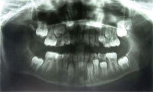 Extensa área radiolúcida mandibular derecha que involucra cóndilo y apófisis coronoides.