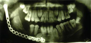 Aspecto radiográfico con neoformación ósea mandibular que sigue el contorno de placa de reconstrucción de titanio.