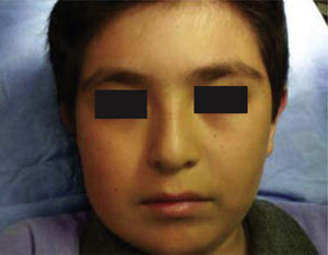 Aspecto facial un año posterior a hemimandibulectomía y colocación de prótesis de reconstrucción mandibular con cóndilo lado derecho.