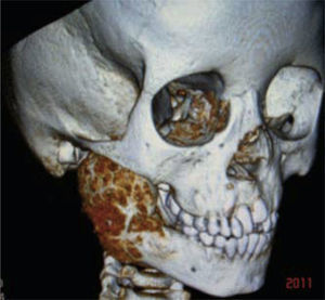Tomografía 3D de osteoblastoma mandibular derecho.