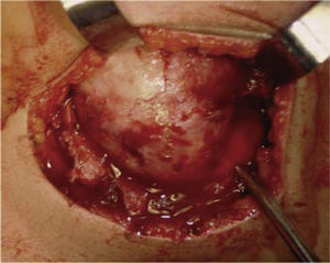 Aspecto quirúrgico de resección de osteoblastoma mandibular derecho.