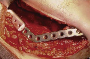 Prótesis mandibular con cóndilo posterior a hemimandibulectomía derecha.