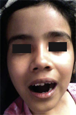 Aspecto facial posterior a dos meses de hemimandibulectomía derecha y colocación de prótesis de reconstrucción con cóndilo.