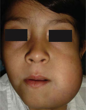 Aspecto facial con ameloblastoma mandibular derecho de cinco meses de evolución.
