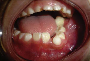 Aspecto intraoral con ameloblastoma mandibular izquierdo de cinco meses de evolución.