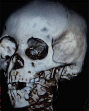Tomografía 3D de amelobastoma mandibular izquierdo, conservando apófisis coronoides y cóndilo.