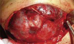 Aspecto quirúrgico de ameloblastoma mandibular derecho conservando continuidad de nervio dentario inferior.