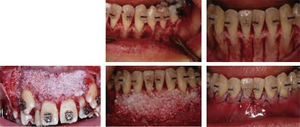 Bone graft placement.10.