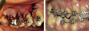 Placement of appliances is recommended one week before corticotomy.12.