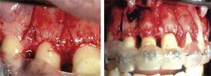 Illustration of «Y» shaped cuts to preserve alveolar crest.16.