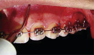 Trans-mucosal corticotomies through incisions previously achieved with electrical scalpel.2.