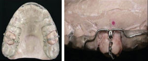 Maxillary modified splint with Nickel-Titanium spring.7.
