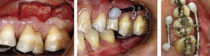 Corticotomy executed in the molar to be intruded, to later place a nickel-titanium spring.7.