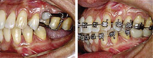 Inter-consultation with orthodontics specialist from beginning of treatment until achieving molar intrusion.7.