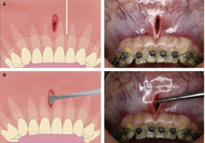 Vestibular approach with 5 to 10mm full thickness incision.6
