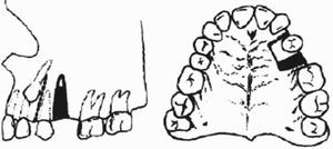 Separation of small bone blocks per dental unit.8.